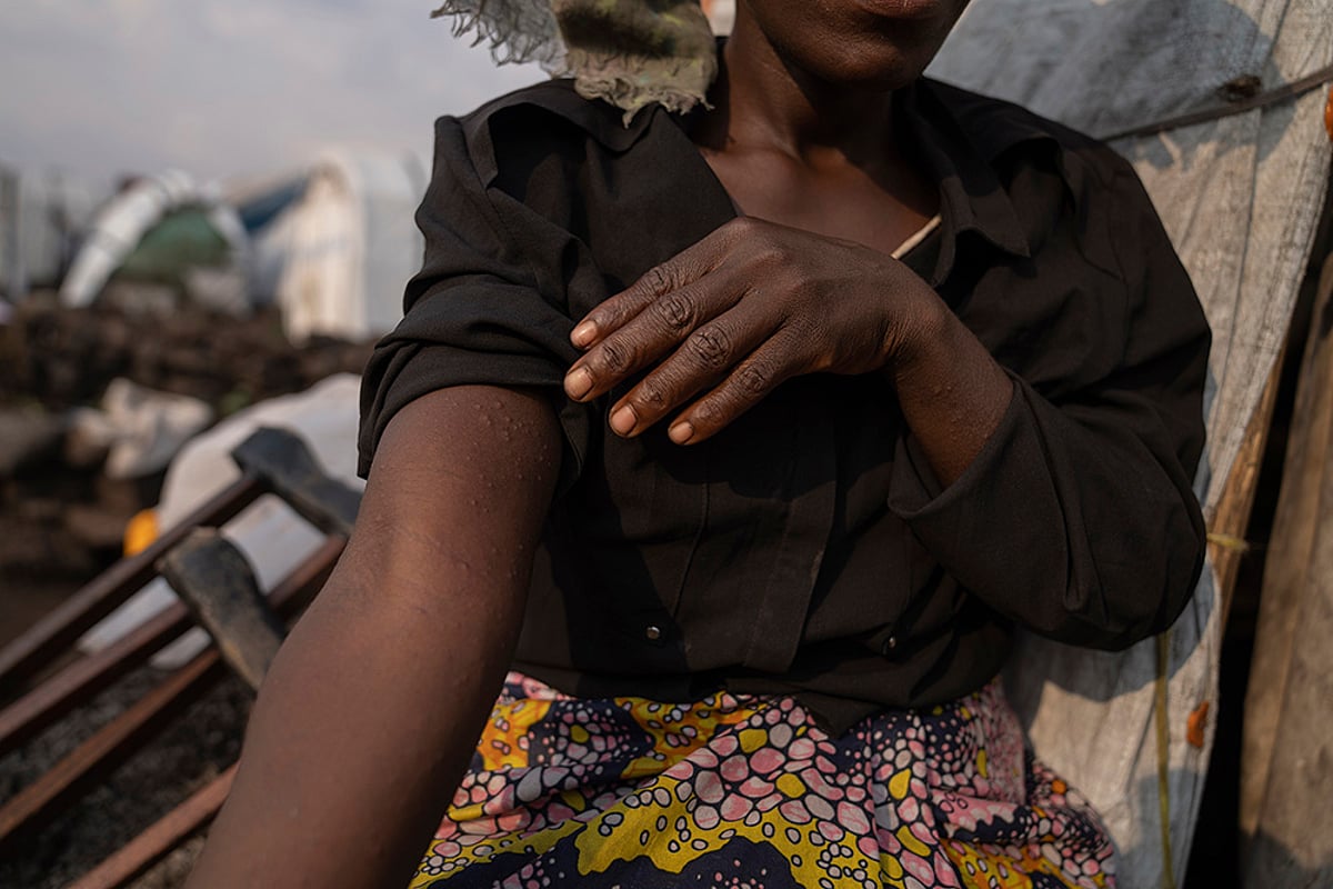 Congo Mpox outbreak_Sarah Bagheni, a suspected patient